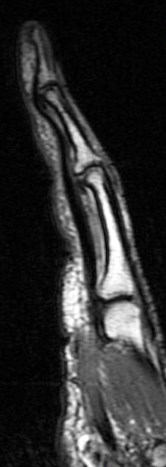 Figure 1 for case A2 pulley rupture finger (RID2437)